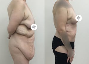 This is one of our beautiful post-bariatric body contouring patient 27