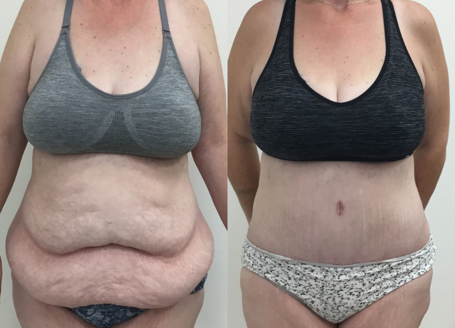 This is one of our beautiful tummy tuck patient 53