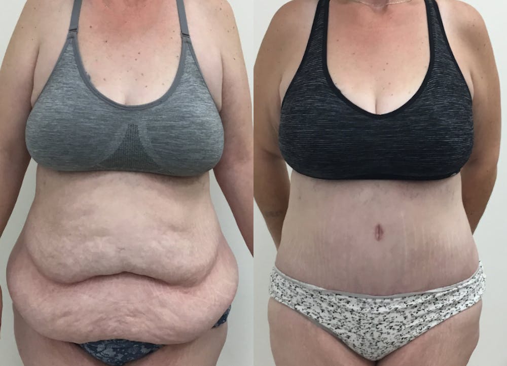 This is one of our beautiful post-bariatric body contouring patient #2