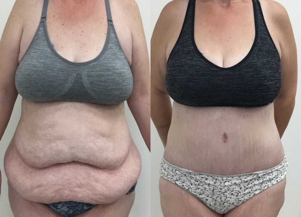 This is one of our beautiful tummy tuck patient #53
