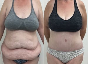 This is one of our beautiful tummy tuck patient 49