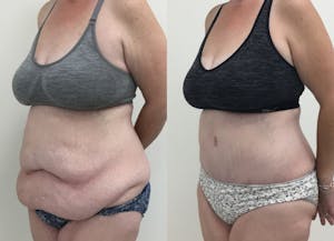 This is one of our beautiful post-bariatric body contouring patient 2