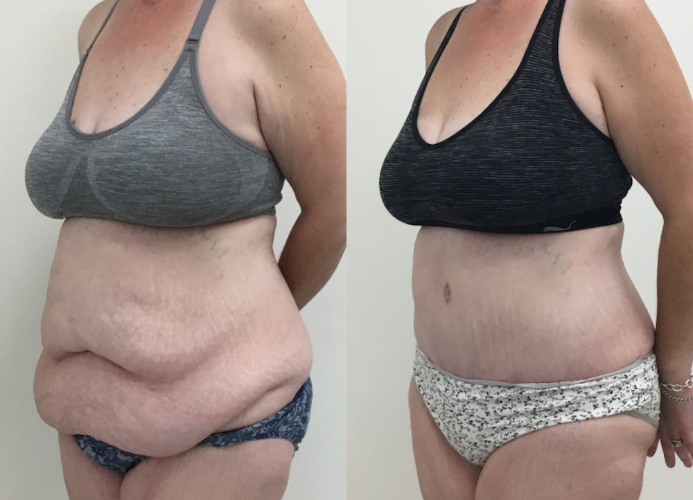 This is one of our beautiful post-bariatric body contouring patient #2