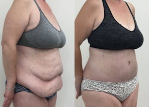 This is one of our beautiful post-bariatric body contouring patient 2