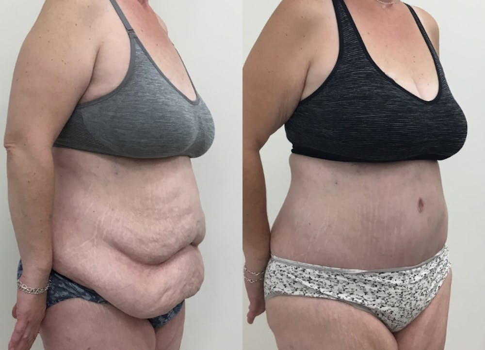 This is one of our beautiful post-bariatric body contouring patient #2