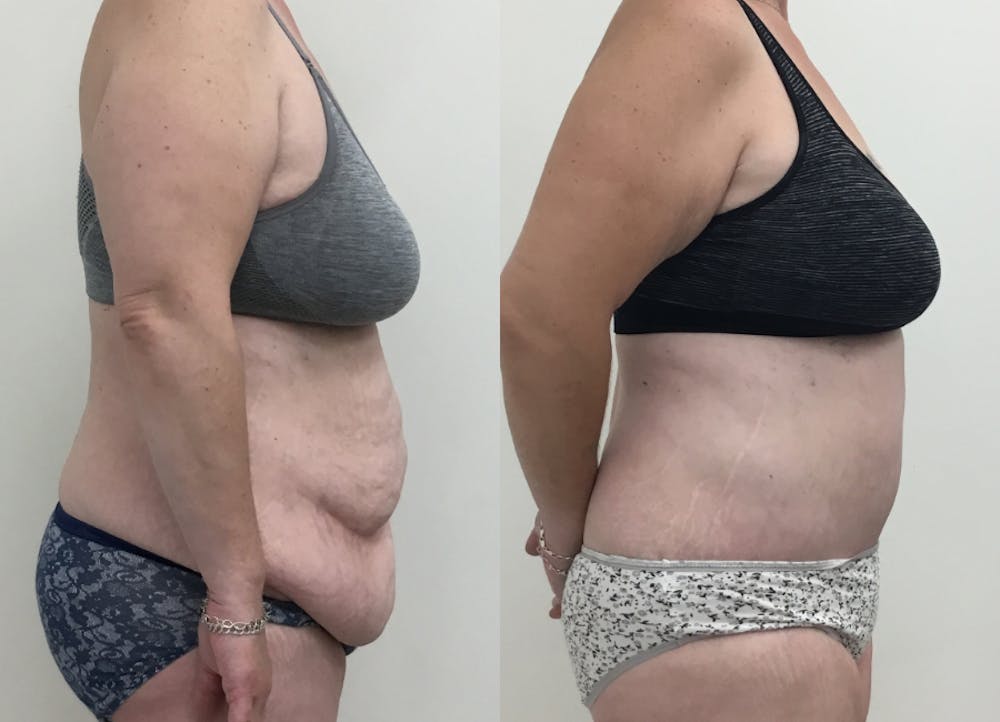 This is one of our beautiful post-bariatric body contouring patient #2