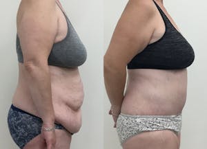This is one of our beautiful post-bariatric body contouring patient 2