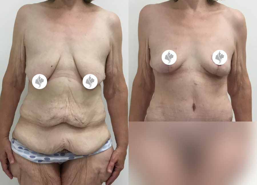 This is one of our beautiful post-bariatric body contouring patient 28