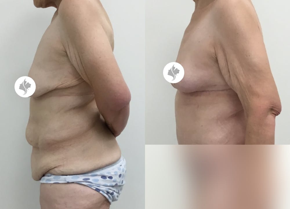 This is one of our beautiful post-bariatric body contouring patient #28