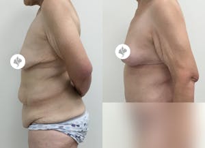 This is one of our beautiful post-bariatric body contouring patient 28