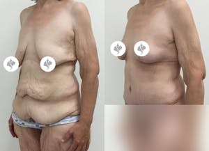 This is one of our beautiful post-bariatric body contouring patient 28