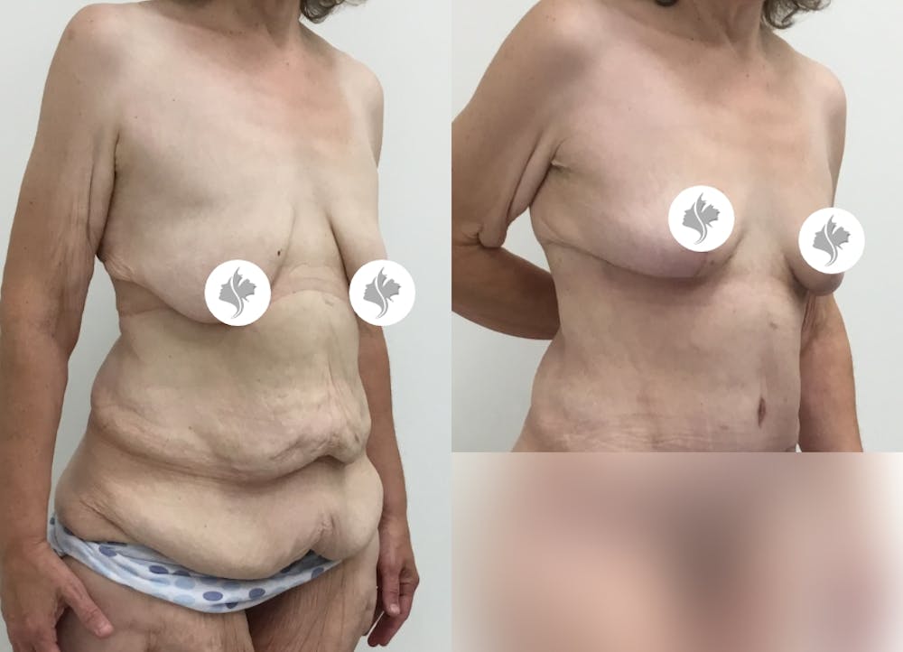 This is one of our beautiful post-bariatric body contouring patient #28