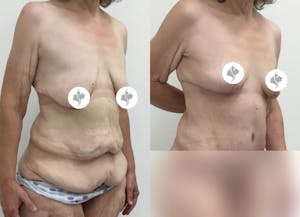 This is one of our beautiful post-bariatric body contouring patient 28