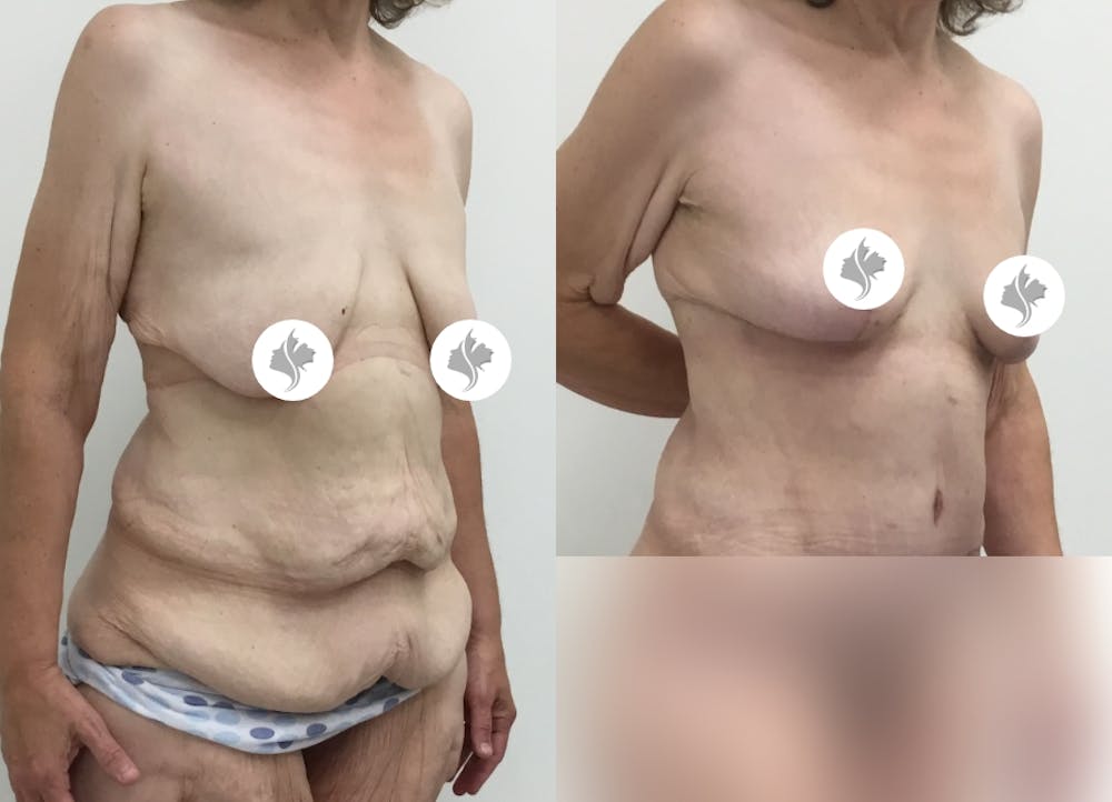 This is one of our beautiful tummy tuck patient #50