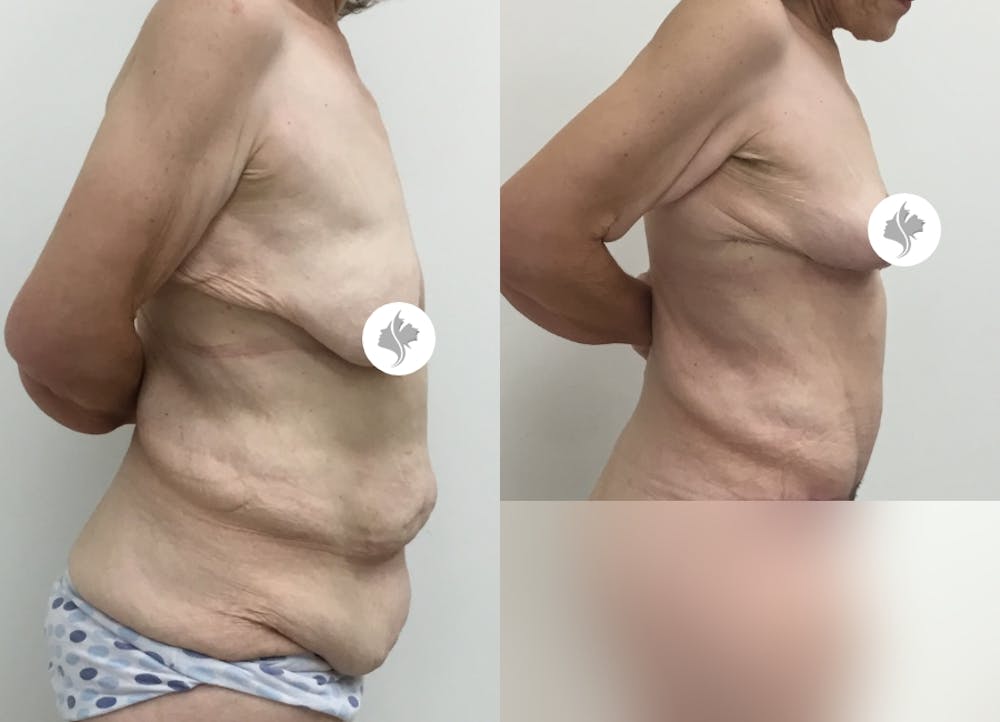 This is one of our beautiful post-bariatric body contouring patient #28