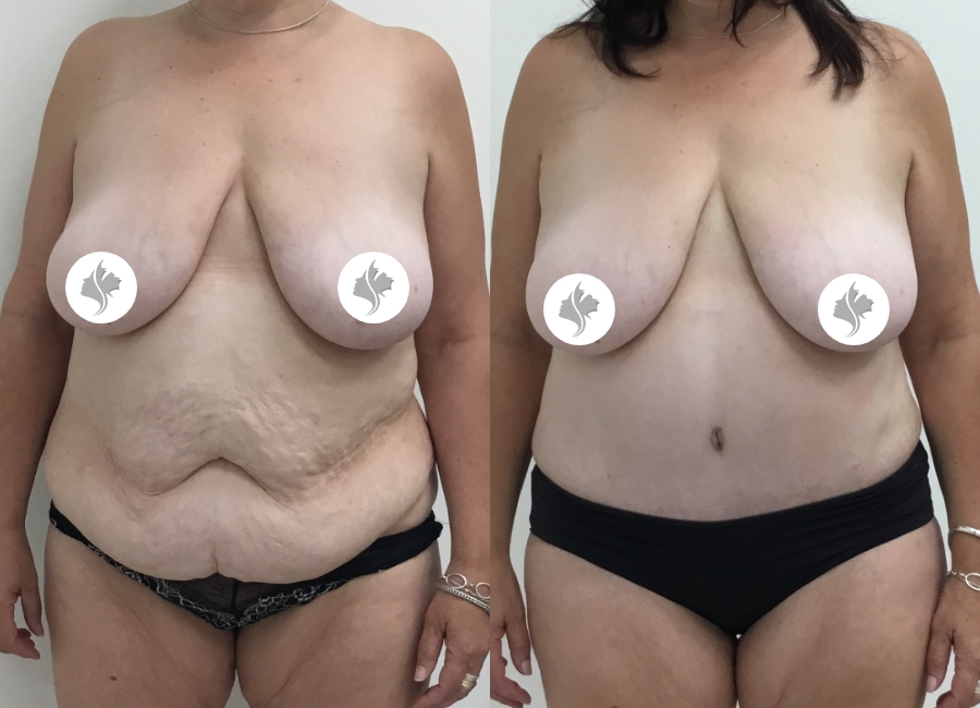 This is one of our beautiful tummy tuck patient 55