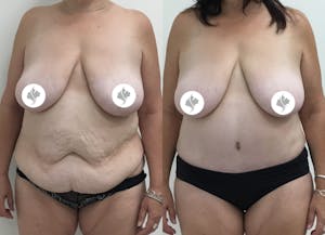 This is one of our beautiful post-bariatric body contouring patient 29