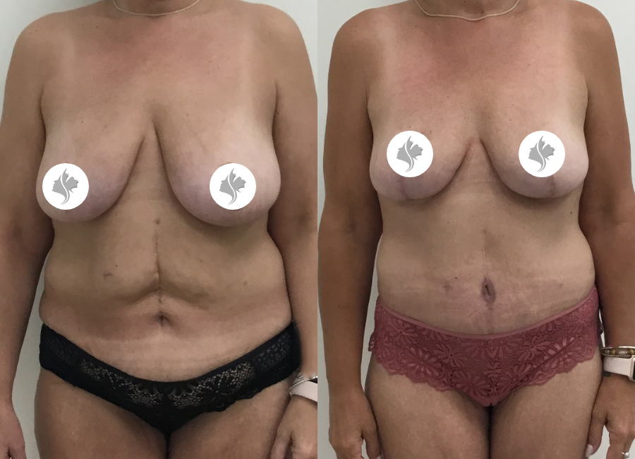 This is one of our beautiful tummy tuck patient 56