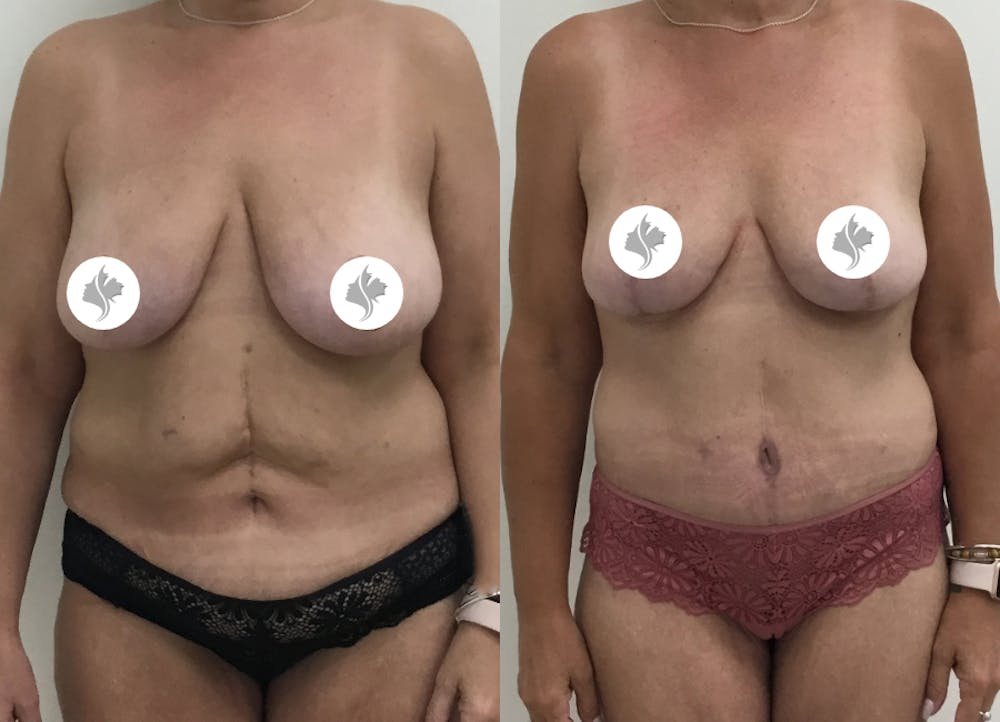 This is one of our beautiful tummy tuck patient #56