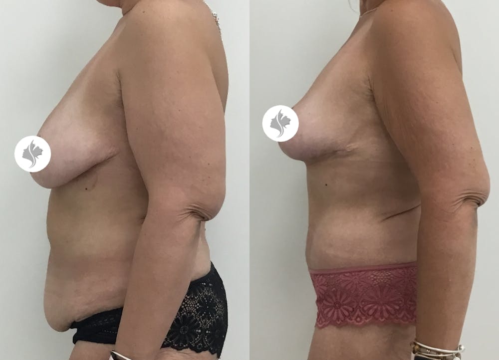 This is one of our beautiful post-bariatric body contouring patient #30