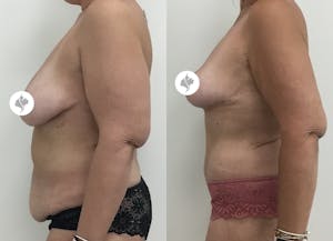 This is one of our beautiful post-bariatric body contouring patient 30
