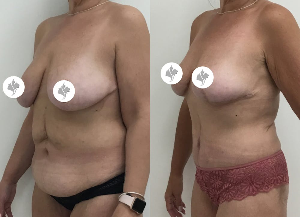 This is one of our beautiful post-bariatric body contouring patient #30