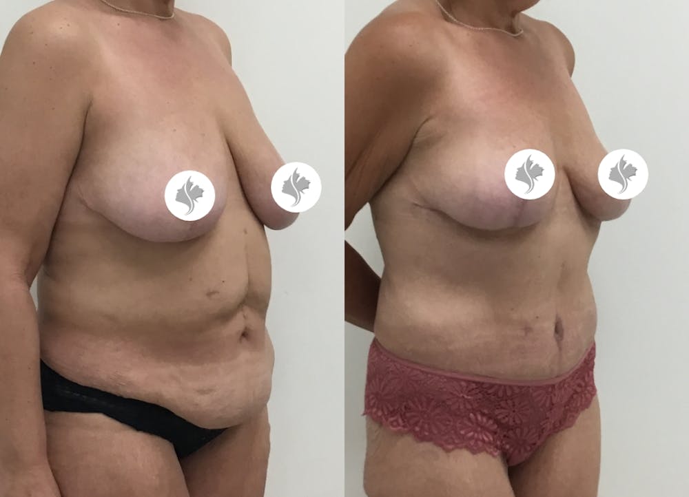 This is one of our beautiful post-bariatric body contouring patient #30