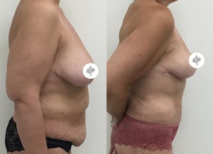This is one of our beautiful post-bariatric body contouring patient 30