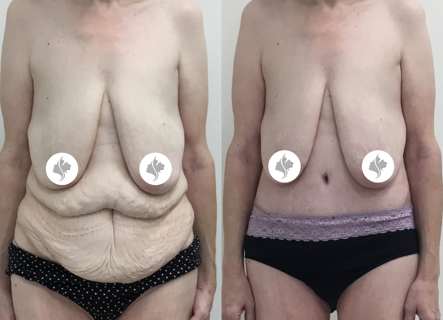 This is one of our beautiful tummy tuck patient 57