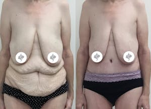 This is one of our beautiful tummy tuck patient 53