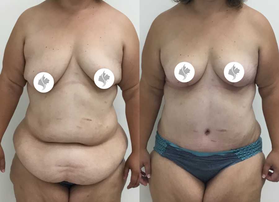 This is one of our beautiful post-bariatric body contouring patient 31