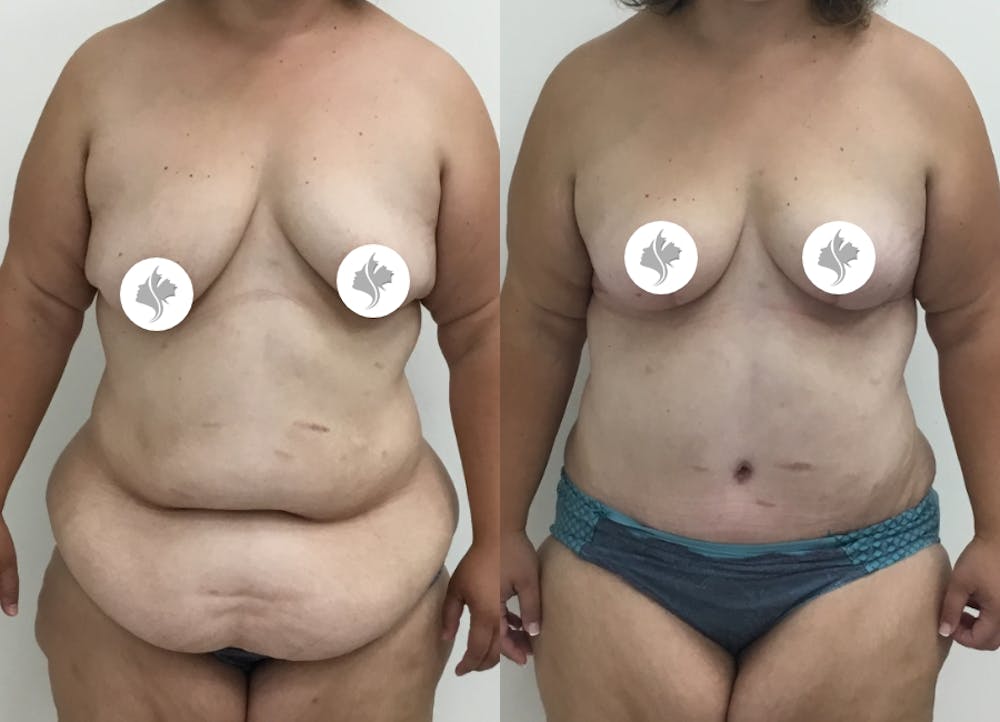 This is one of our beautiful tummy tuck patient #58