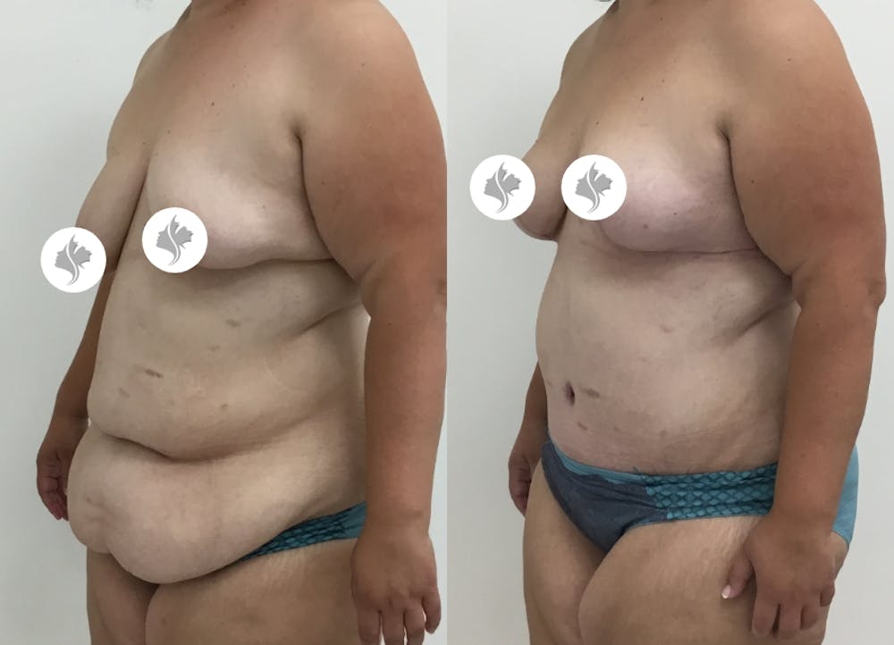 This is one of our beautiful post-bariatric body contouring patient #31