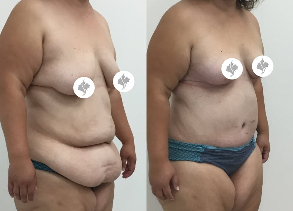 This is one of our beautiful post-bariatric body contouring patient #31