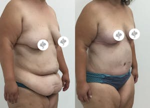 This is one of our beautiful tummy tuck patient 54