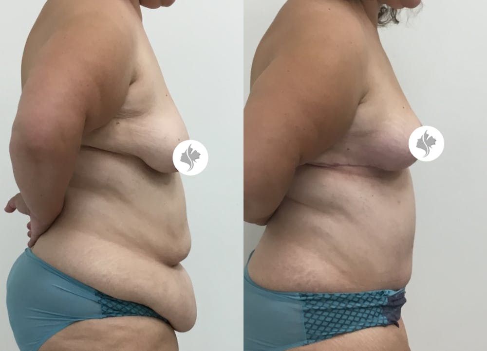 This is one of our beautiful post-bariatric body contouring patient #31