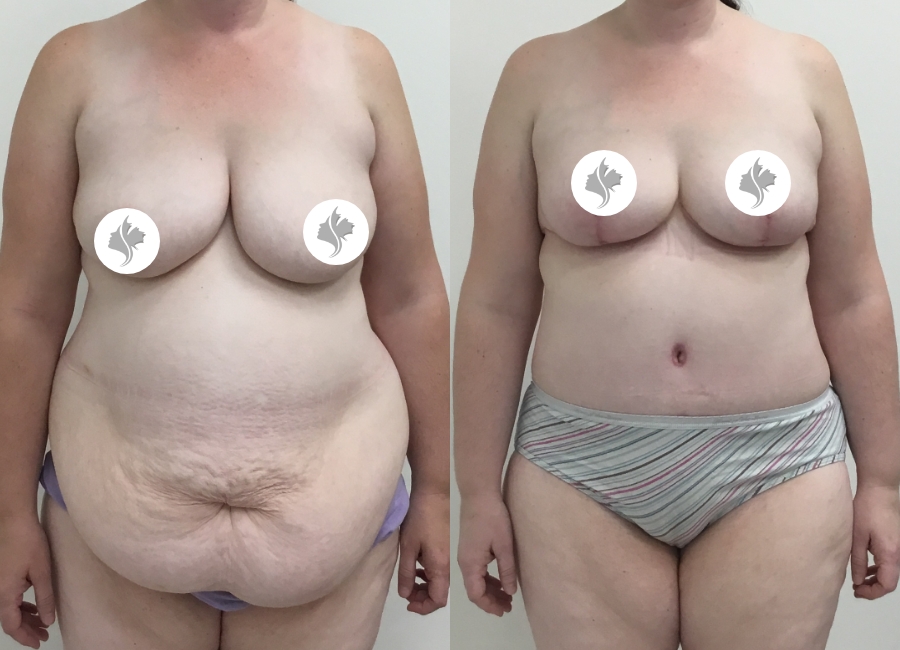 This is one of our beautiful tummy tuck patient 59