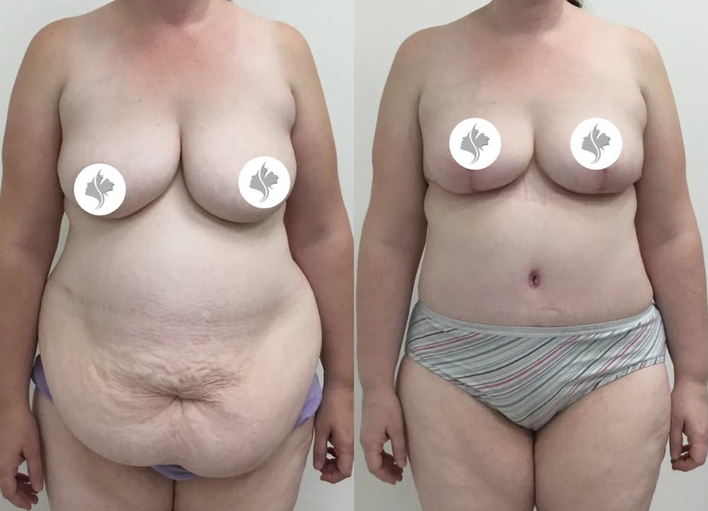 This is one of our beautiful post-bariatric body contouring patient #32