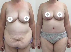 This is one of our beautiful post-bariatric body contouring patient 32