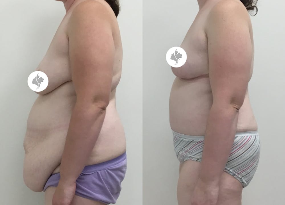 This is one of our beautiful post-bariatric body contouring patient #32