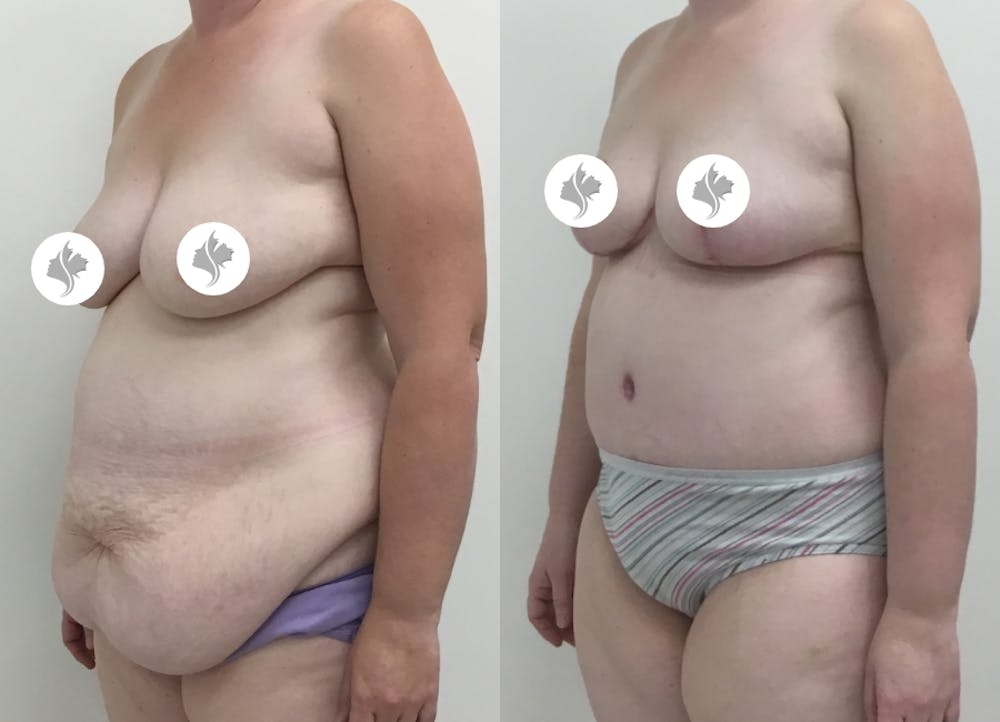 This is one of our beautiful post-bariatric body contouring patient #32