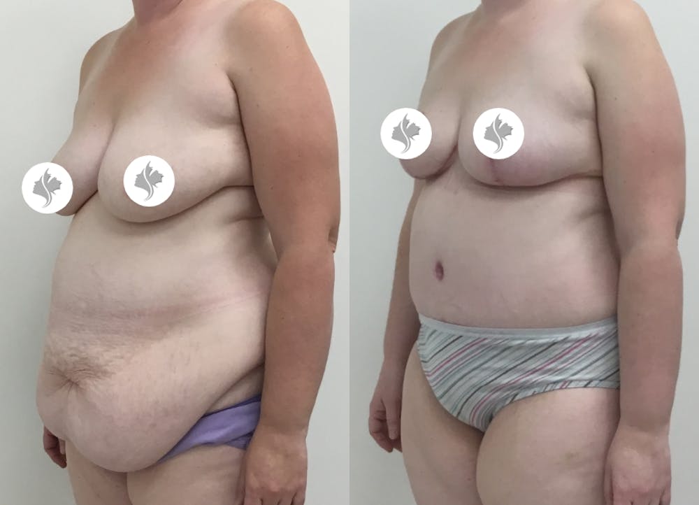 This is one of our beautiful tummy tuck patient #59