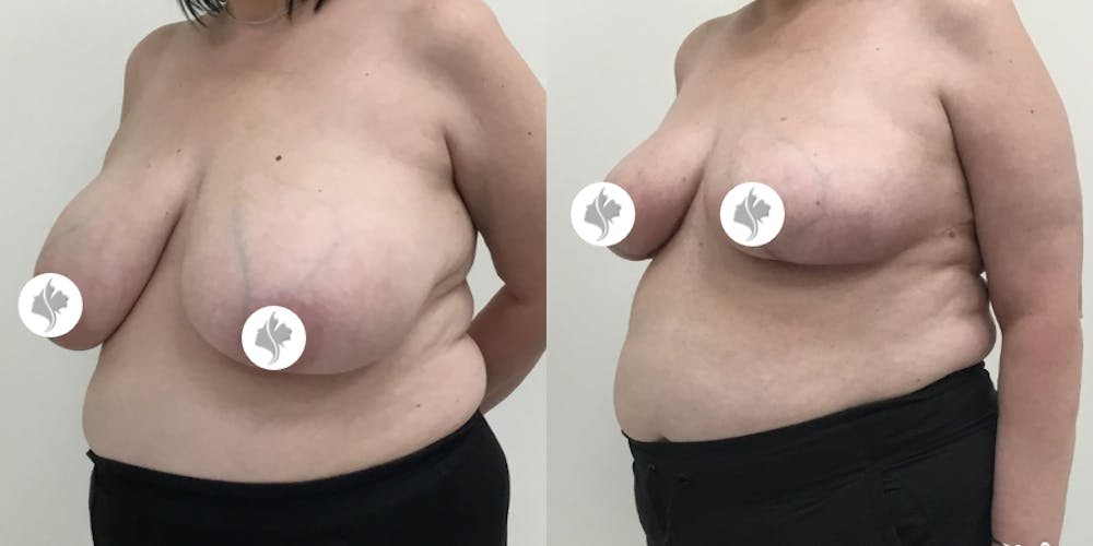 This is one of our beautiful breast reduction patient #68