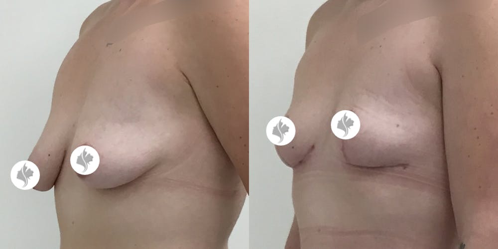 This is one of our beautiful breast reduction patient #66
