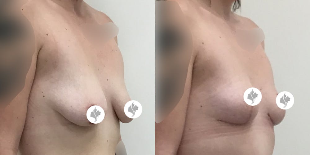 This is one of our beautiful breast reduction patient #66