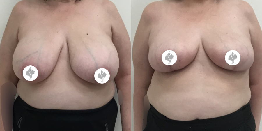This is one of our beautiful breast reduction patient 68
