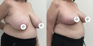 This is one of our beautiful breast reduction patient 68