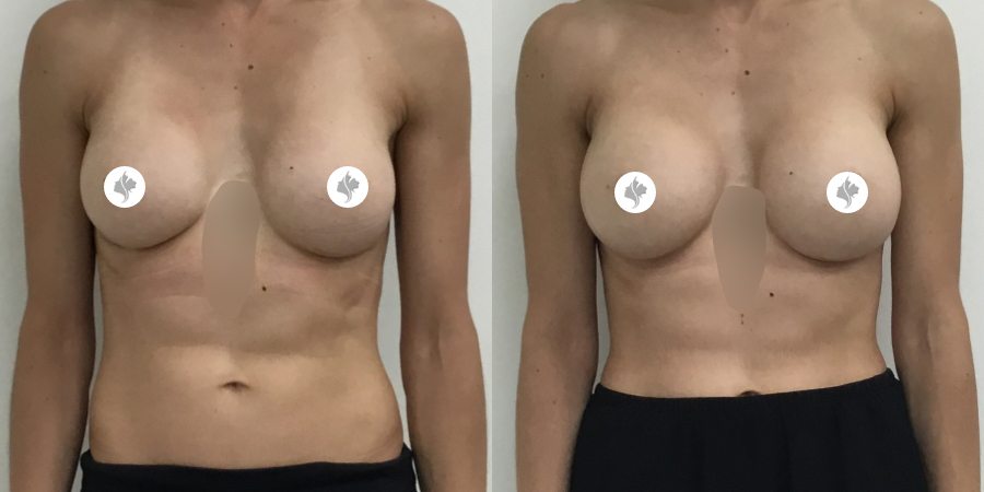 This is one of our beautiful breast augmentation patient 2
