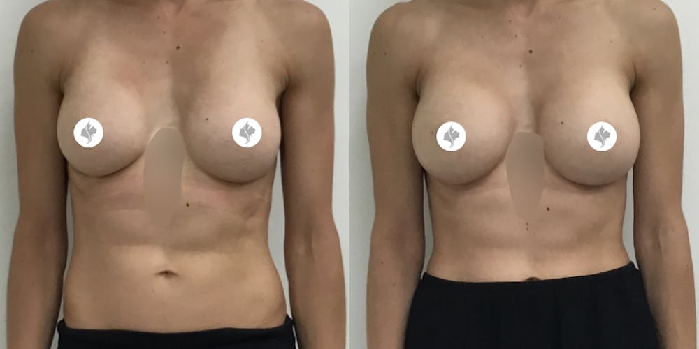 This is one of our beautiful breast augmentation patient #2