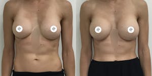 This is one of our beautiful patient 1 patient 1
